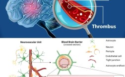 脑梗塞研究热点与未来方向何在？