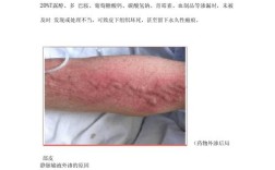 静脉输液外渗的研究阶段