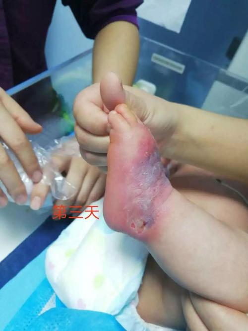 静脉输液外渗的研究阶段-图3 静脉输液外渗的研究阶段-图3