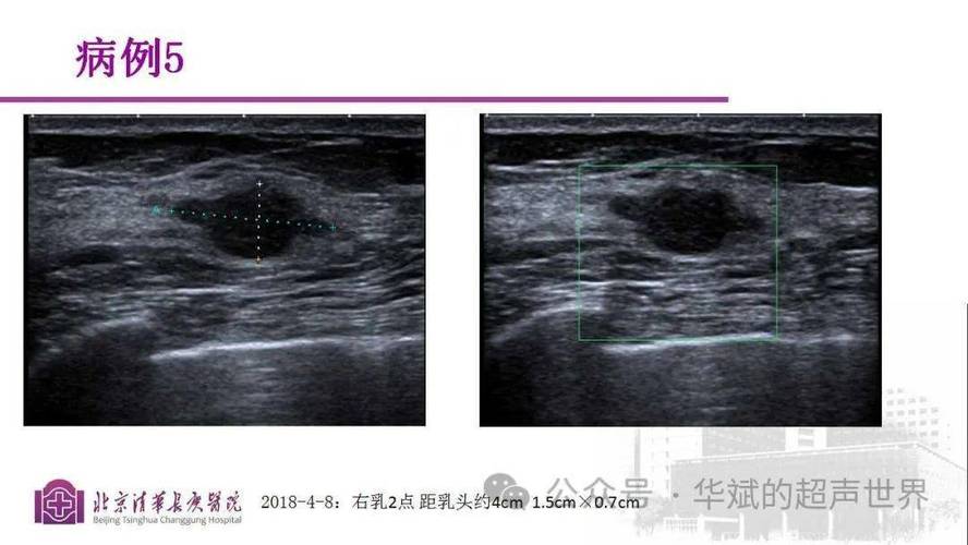 乳腺癌超声论文参考文献-图3