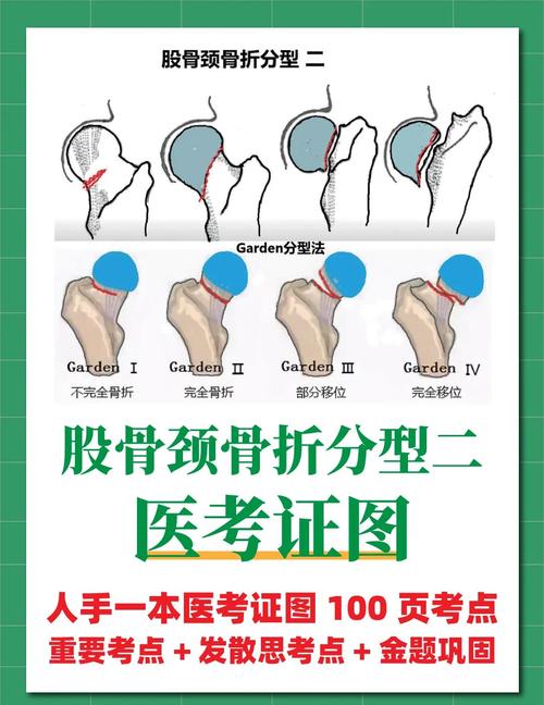 论文股骨颈骨折参考文献-图3 论文股骨颈骨折参考文献-图3