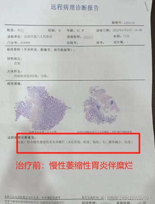 胃溃疡的成因与治疗新进展是什么？-图1